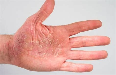 Экзема - причины и лечение | Kosmetologiya-dermatologiya.az