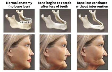 About Missing Teeth - SD Dental Cleveland