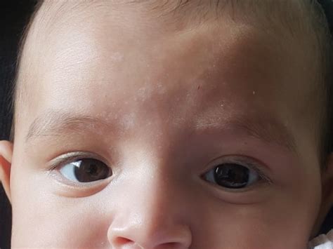 Mancha Branca No Braço Do Bebe - Manchas no bebê | BabyCenter