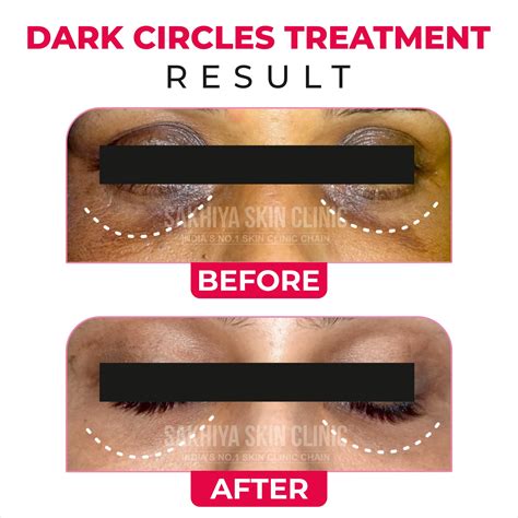 dark circles treatment home 7