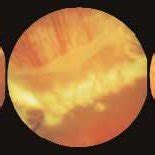 (PDF) Complications of Scleral Buckling