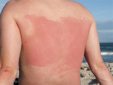 uv danger hundreds  victorians hospitalised  severe sunburns