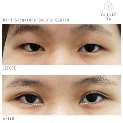 clinic rx       rxs double eyelid