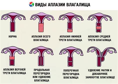 Aplasia vaginului: cauze, simptome, diagnostic, tratament