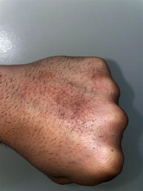 The Unbelievable Blackhead Removal 2024 Secret Dermatologists Don't Want You To Know! Image 9