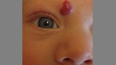 Baby has a hemangioma: how to recognize it and treat it? – Healthy Food ...