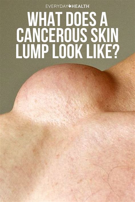 Why Do I Have A Lump Under My Skin - Printable Templates Protal