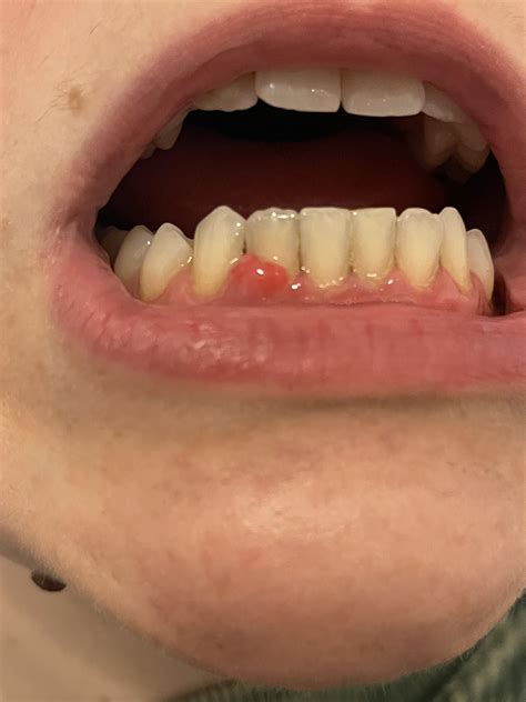 Help my gum on this tooth is swollen and moves side to side … have