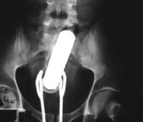 25 Crazy Things Seen in X-Rays | eBaum's World