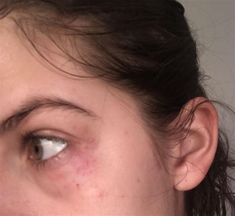 Causes and Treatments for Red Dots on Your Eyelids 16