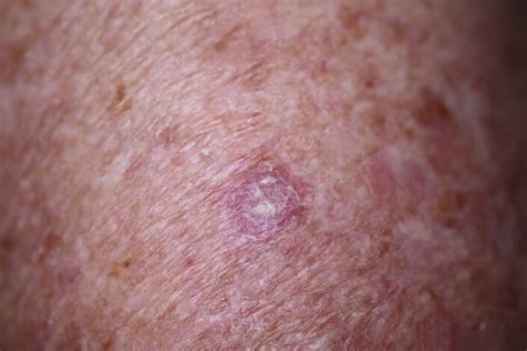 Dermatofibroma - South East Skin Clinic blog