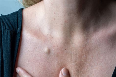 cystic cysts  signs symptoms diagnoses treatments