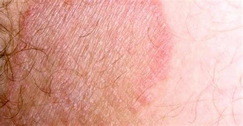 Best thing for jock itch rash - Lasisales
