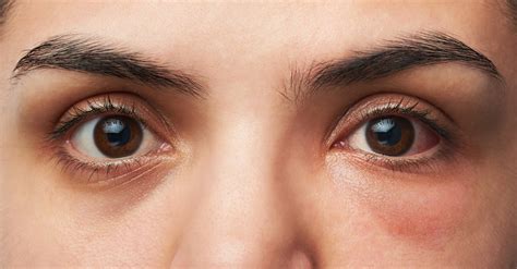 Apa Itu Racoon Eye atau Mata Rakun, Gejala hingga Penyebab