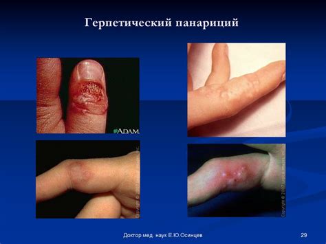 Гнойные заболевания кисти - презентация онлайн