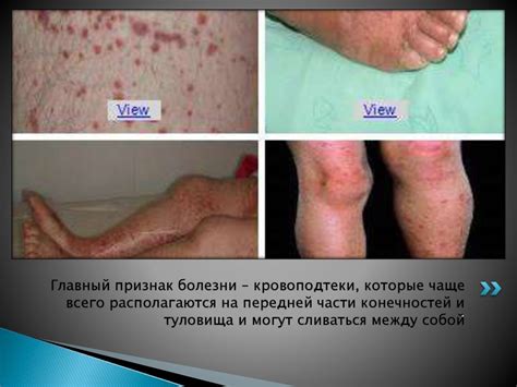 Болезнь Верльгофа (хроническая иммунопатологическая ...