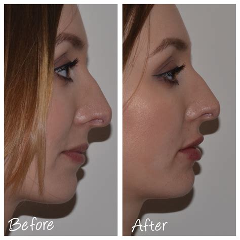 A-Z of Dermal Fillers - Cosmetic Courses