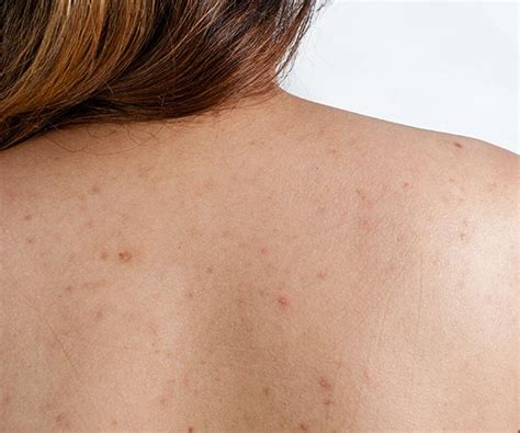 sneaky reason youre  backne  acne shefinds