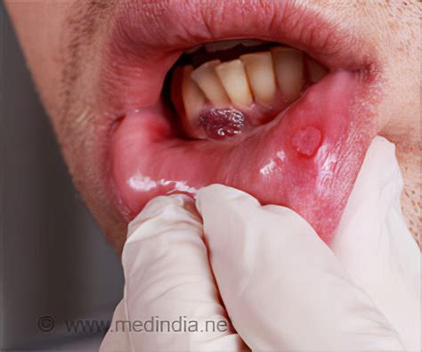 oral cancer lip