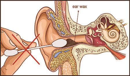 Ear Wax Anatomy