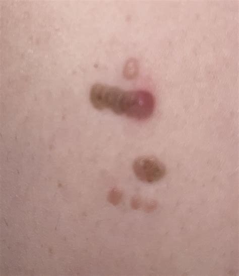 Brown spots turned red : r/DermatologyQuestions