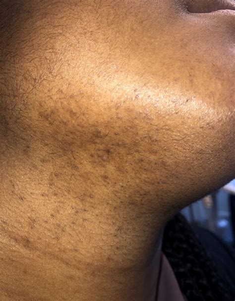 Erythematous Papules and Pustules on Face- Clinical Advisor