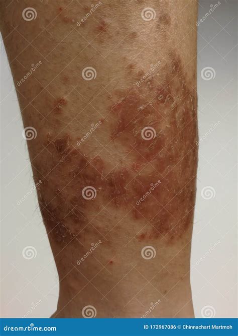 Junge Hat Chronische Hautausschlag Auf Die Haut Allergische