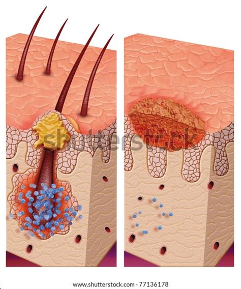 Herpetic Folliculitis Photos and Images | Shutterstock