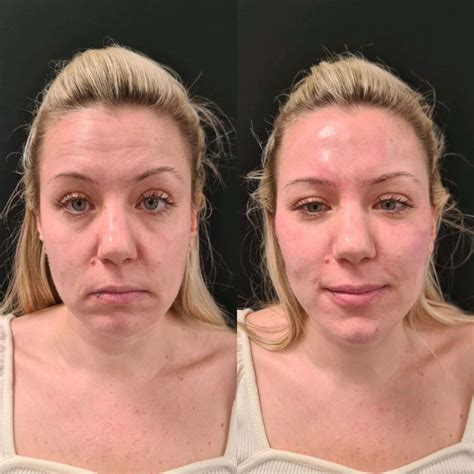 Derma Medical Full Facial Transformation Masterclass - Derma Medical