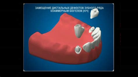 Бюгельный протез для нижней челюсти на кламмерах - YouTube