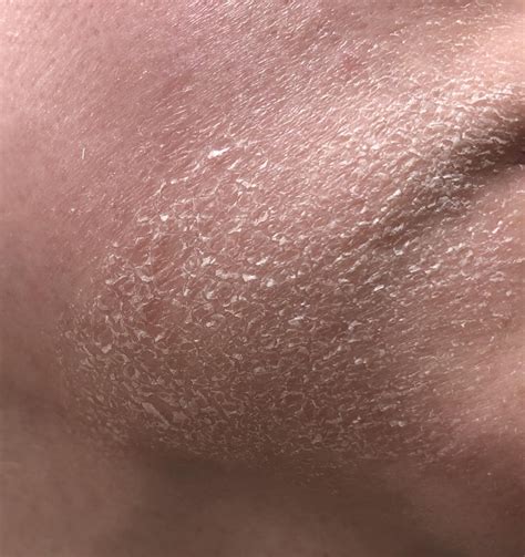 Steroid Creams, Aklief, Epsolay? : r/Rosacea