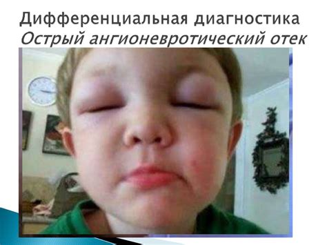 Ложный круп: клиника, дифференциальная диагностика, лечение ...