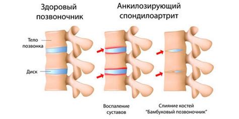 Нимид Форте. Инструкция и показания по применению. Цена. Аналоги. Отзывы
