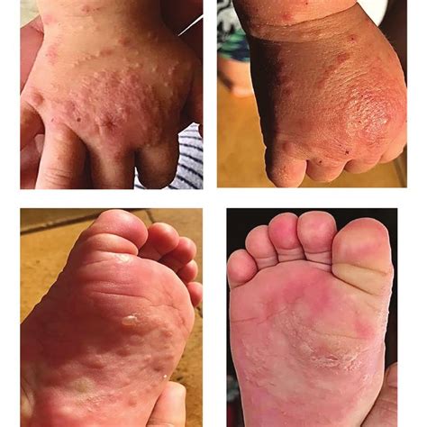 case  recurrent vaccine triggered gianotti crosti syndrome