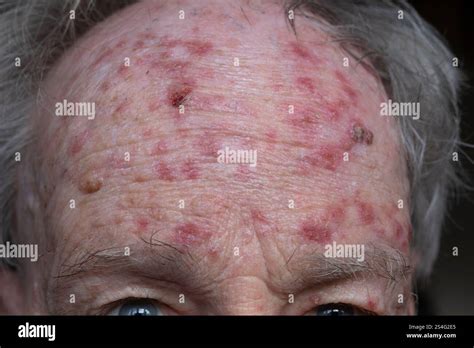 Forehead of man during treatment for actinic keratosis with Flurouracil ...