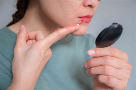 What Does a Cold Sore Look Like? Pictures and Symptoms