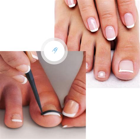 Ingrown Nail | Foundation Health