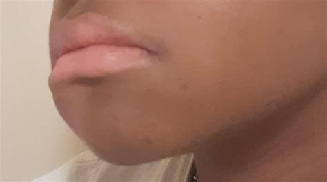 Prolonged swollen cheek : r/DermatologyQuestions