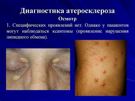 Заболевания сердечно-сосудистой системы. Атеросклероз - презентация онлайн