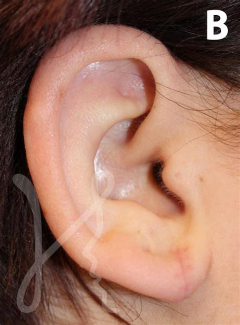 Earlobe Repair by Dr. Brian Harmych