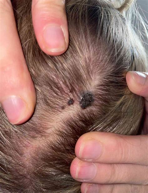Woman, 29, Was Told Her a Mole on Her Scalp Was Fungus But It Was