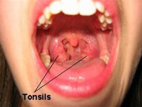 Throat Infection Without Tonsils