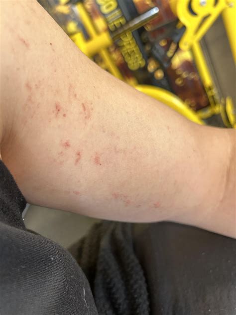 Localized Rash on left bicep : r/DermatologyQuestions