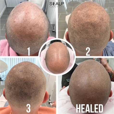 Our Clients ️ it | Before & After Scalp Micropigmentation for Men