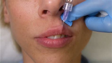 Плоский бант 100 % #обучениекосметологов #губы #filler #fillerlips # ...