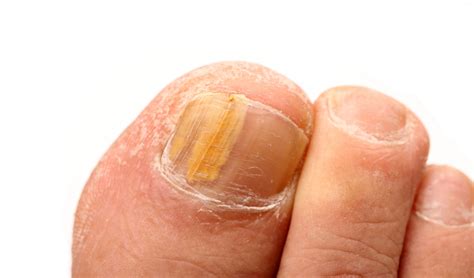 How to Treat Fungal Toenail Infections