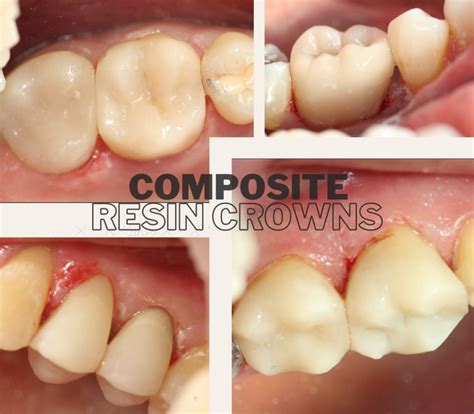 SAVE TIME, SAVE MONEY and SAVE YOUR TEETH - BelleDental - November 17, 2023