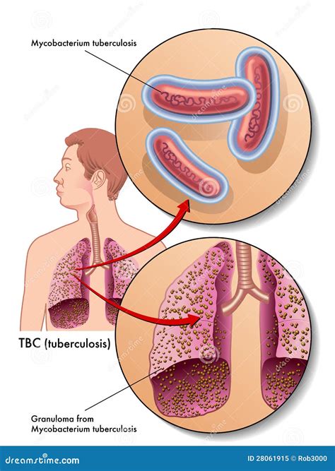 Symptoms Of Tuberculosis. World Tuberculosis Day. March 24. The
