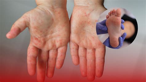 ¿Qué es el Virus de Coxsackie?