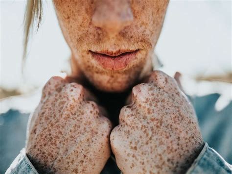 Macules: Macules Causes, Treatments and More